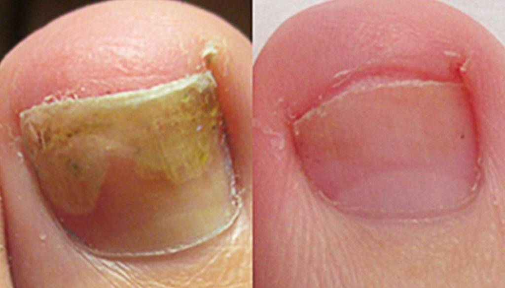 Benefits toe nail fungus.jpg