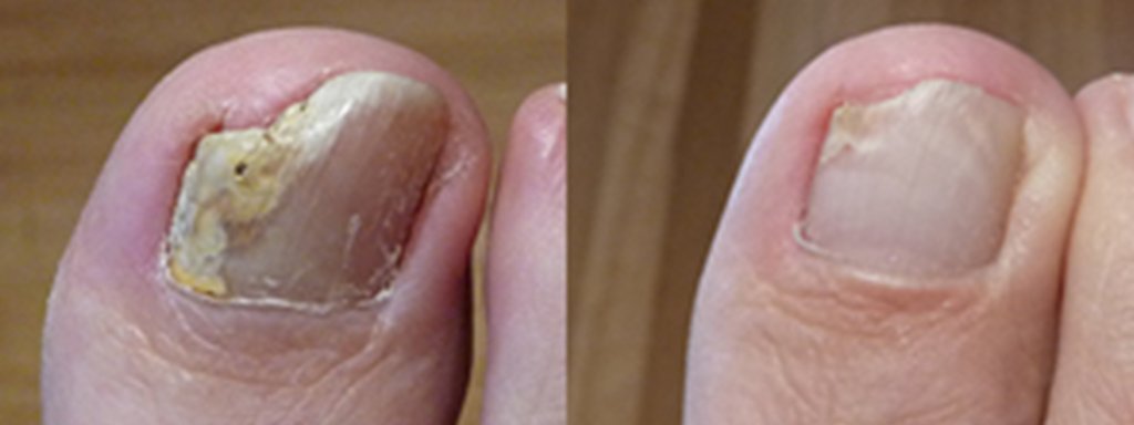 Recovered nail.jpg
