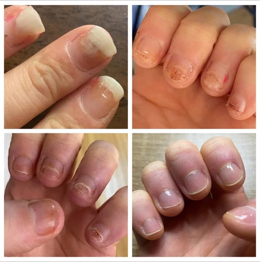 Toenail fungus cured.jpg